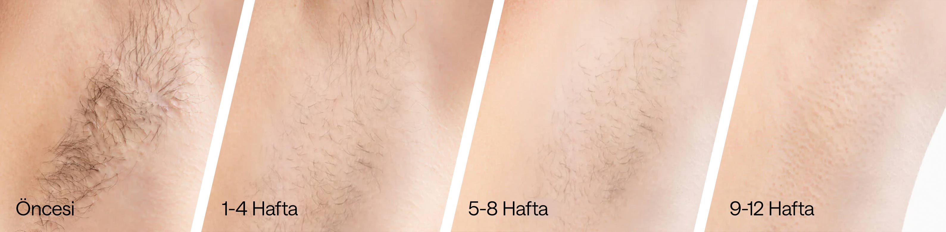 Cilt hassasiyetine ve farklı vücut bölgelerine